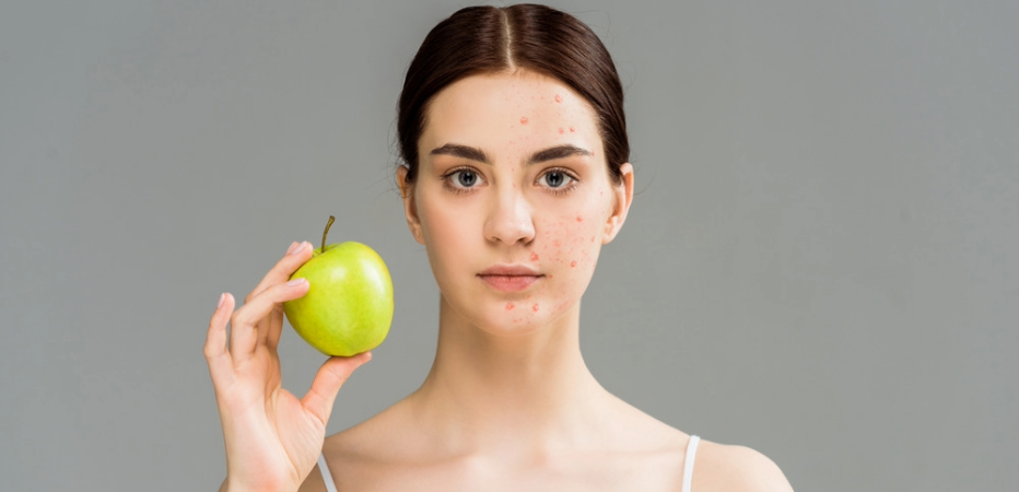acne_1
